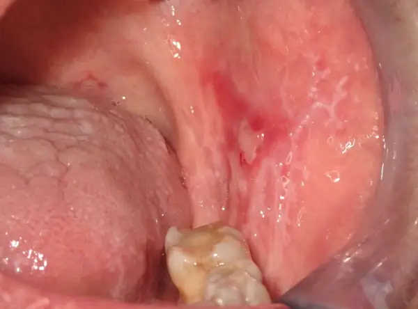 Lesioni biancastre e rosse nella bocca, indicative di lichen planus orale, in attesa di terapia.
