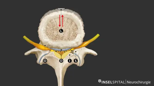 Querschnitt einer Wirbelsäule mit Darstellung der neuroforaminalen Enge. Ein Nerv (gelb) wird durch knöcherne Strukturen und Gewebe eingeengt.
