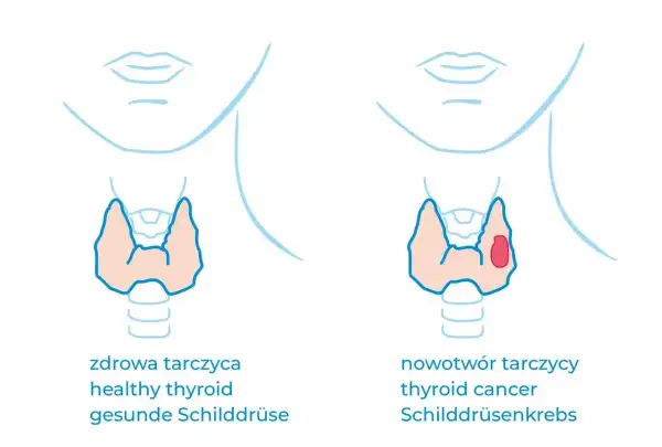 Vergleich von gesunder Schilddrüse und Schilddrüsenkrebs. Bei Krebs ist calcitonin erhöht, was auf eine Veränderung hinweist.