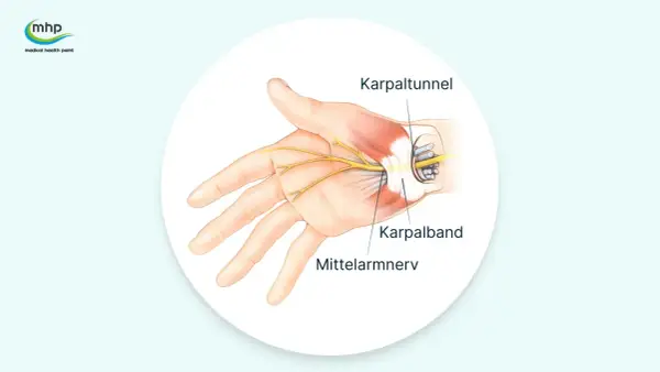 Anatomische Darstellung des Karpaltunnels, der den Mittelarmnerv und das Karpalband zeigt. Mögliche Ursachen für Karpaltunnelsyndrom Symptome.