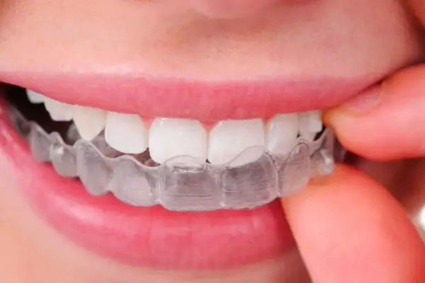 Denti allineati con Invisalign, una scelta discreta anche in gravidanza per un sorriso perfetto.