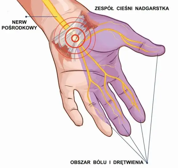 Cieśń nadgarstka: Do jakiego lekarza się udać? Sprawdź!