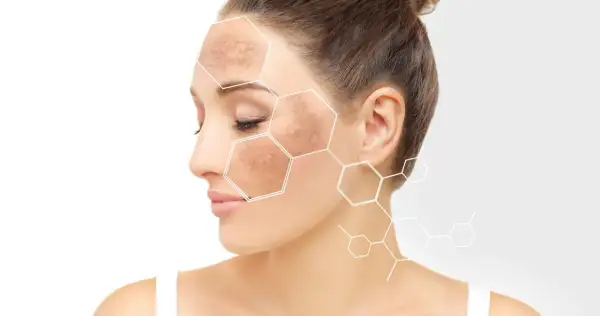 Mujer con manchas en la cara, destacadas con un patrón hexagonal.
