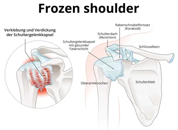 Schultergelenk mit verdickter Kapsel und entzündetem proc coracoideus. Veranschaulicht die Verklebung der Schultergelenkkapsel bei Frozen Shoulder.