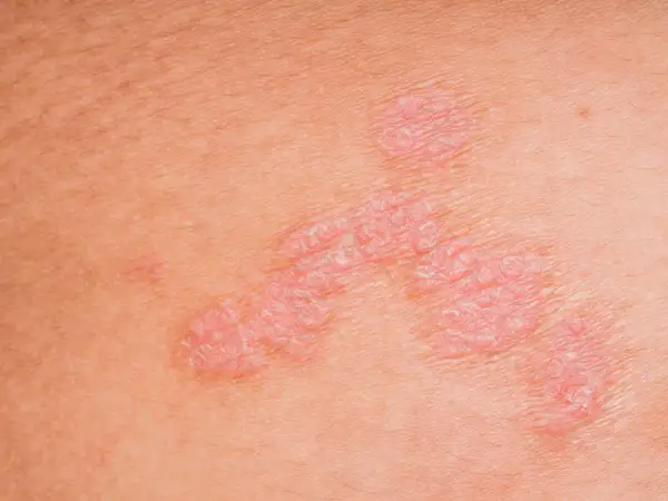 Nahaufnahme von **neurodermitis schuppiger haut**. Rote, erhabene Stellen mit silbrigen Schuppen auf der Haut.