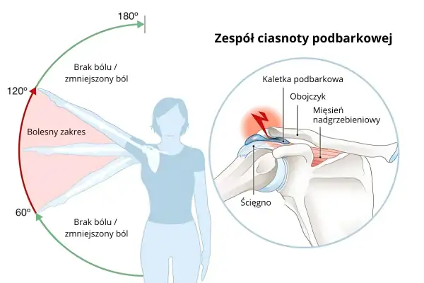 Ilustracja przedstawia zakres ruchu ramienia z zaznaczonym bólem oraz przekrój stawu barkowego z zaznaczonymi strukturami.
