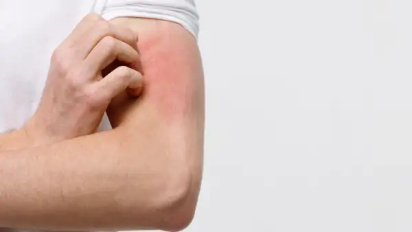 Juckende Haut am Arm, rot und gereizt. Was tun bei Hautjucken?