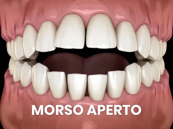 Denti bianchi e gengive rosa mostrano un morso aperto, con uno spazio evidente tra gli incisivi superiori e inferiori.