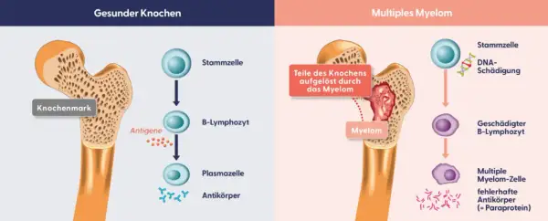 Vergleich gesunder Knochen mit Multiplem Myelom. Myelomzellen schädigen Knochen und produzieren fehlerhafte Antikörper, was zu Knochenschäden und Begleiterkrankungen führt.