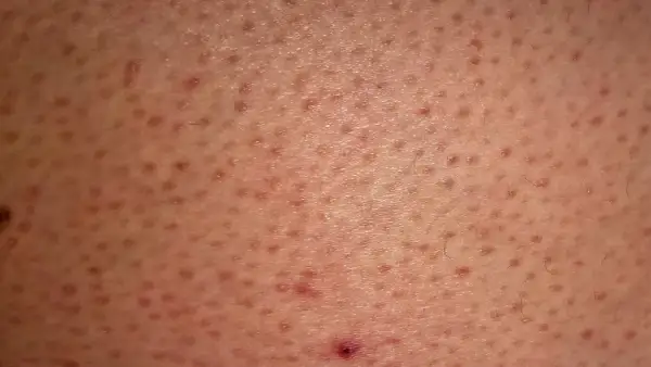 Skóra z licznymi drobnymi grudkami i zaczerwienieniami, charakterystycznymi dla rogowacenia mieszkowego (keratosis pilaris).