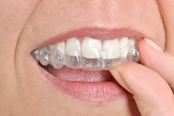 Dita che rimuovono un apparecchio trasparente, mostrando come togliere Invisalign per una pulizia rapida.