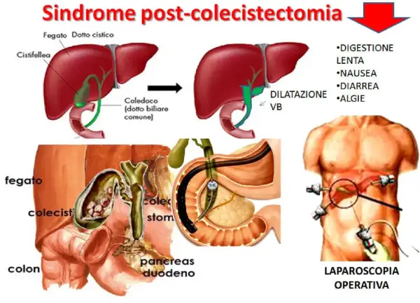 Illustrazione della sindrome post-colecistectomia, con diagrammi del fegato, cistifellea e vie biliari, e immagini di chirurgia laparoscopica. Vivere senza cistifellea può comportare disturbi digestivi.