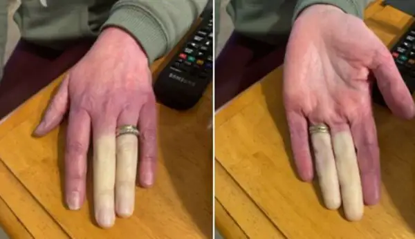 Zimne palce? Objawy Raynauda, czerwone flagi i diagnoza