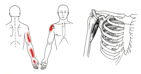 Schmerzpunkte am Arm und Schulterbereich, die auf den m coracobrachialis hinweisen. Detailansicht des Schultergelenks mit Muskeln und Rippen.