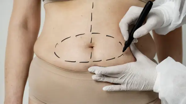Liposukcja brzucha: Modelowanie czy odchudzanie? Poznaj prawdę!