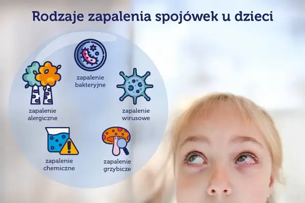 Rodzaje zapalenia spojówek u dzieci: alergiczne, bakteryjne, wirusowe, chemiczne, grzybicze.