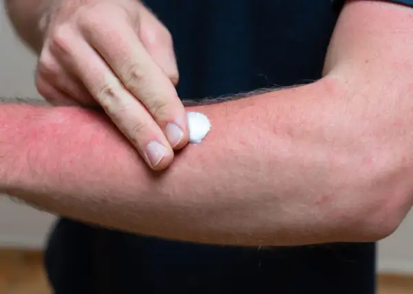 Mann trägt Salbe auf stark geröteten Arm auf, der unter brennender Haut leidet.