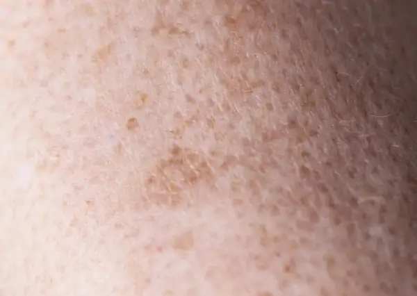 Zbliżenie na skórę z przebarwieniami, gdzie widać nierównomierne rozmieszczenie melaniny. To właśnie melanina co to jest, decyduje o kolorze skóry.