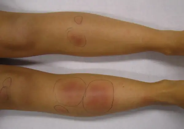 Gambe con segni di pizzichi, arrossamenti e gonfiori evidenziati da cerchi a matita.