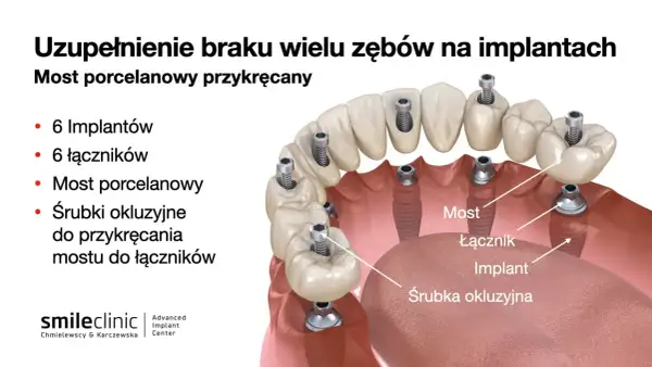Ilustracja pokazuje, jak uzupełnić brak jednego zęba za pomocą mostu porcelanowego przykręcanego na 6 implantach. Widoczne są implanty, łączniki i śrubki.