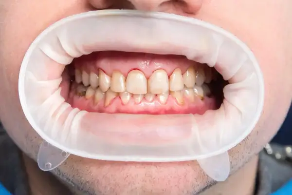 Usta z rozwierakiem dentystycznym, widoczne zęby z przebarwieniami i zaczerwienionymi dziąsłami, sugerujące próchnicę początkową.