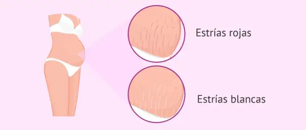 Ilustración de abdomen de embarazada con primeros planos de estrías rojas y blancas, mostrando las marcas comunes del embarazo.