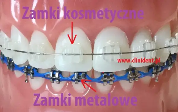 Aparat na zęby: zobacz, jak wygląda! Od metalu po niewidoczne