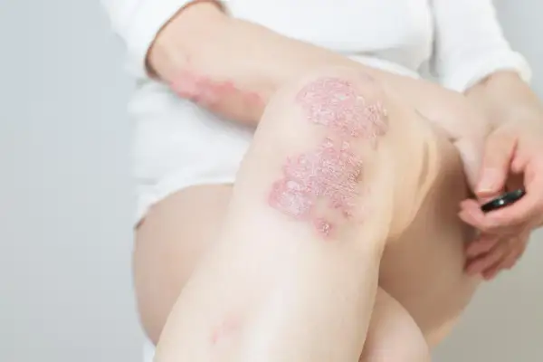 Skóra z łuszczycą na kolanie i ramieniu. Czy łuszczyca jest zaraźliwa? Nie, to choroba autoimmunologiczna.