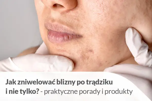 Jak usunąć blizny domowym sposobem? Skóra z widocznymi śladami po trądziku, usta i podbródek.