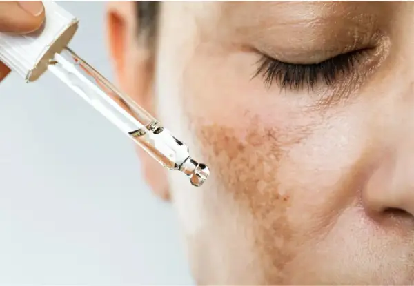 Gotas de suero aplicándose sobre manchas melasma en la mejilla de una persona.