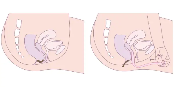 Schéma pelvien montrant une rectocèle. La deuxième image illustre une intervention pour traiter la rectocèle est-ce grave.