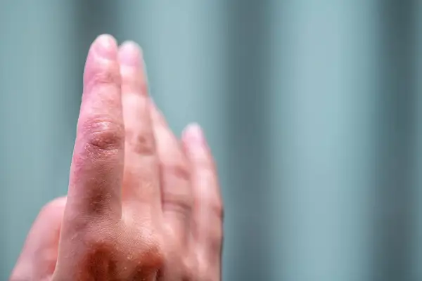 Skóra na opuszkach palców rąk jest zaczerwieniona i lekko łuszcząca się, co może wskazywać na swędzenie opuszków palców u rąk.