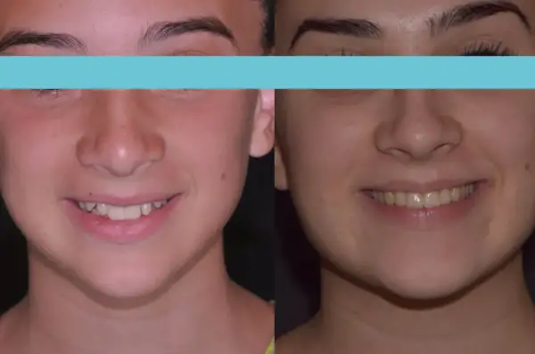 Prima e dopo: un sorriso più armonioso con una mascella pronunciata che valorizza il volto.