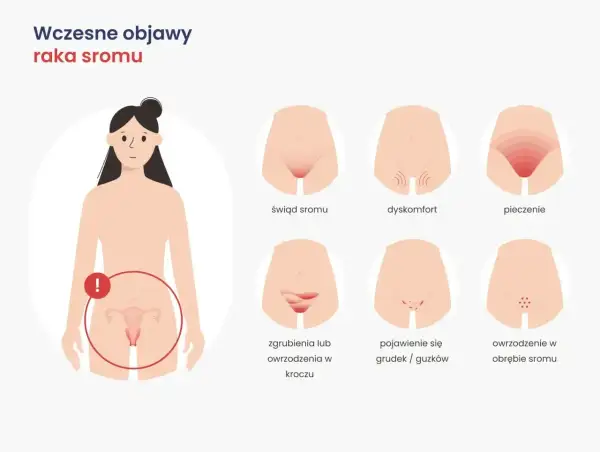 Ilustracja pokazuje wczesne objawy raka sromu: świąd, dyskomfort, pieczenie, zgrubienia, grudki i owrzodzenia.