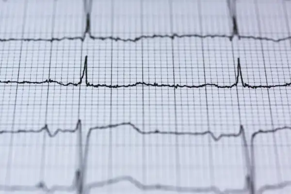 EKG pokazuje rytm serca. Czy nerwica serca wyjdzie na EKG? Zapis pokazuje fale, które mogą być interpretowane przez lekarza.