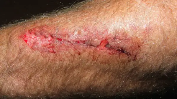 Zakażona rana z tężcem: zaczerwieniona, krwawiąca, z widocznymi strupami i tkanką. Skóra wokół jest podrażniona.