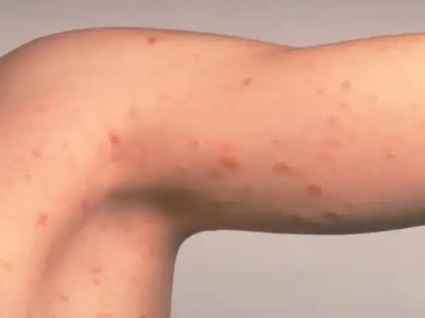 Brazo con erupción de pequeños puntos rojos, posiblemente hongos, manchas rosadas en la piel.