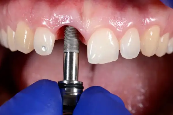 Zabieg wszczepienia implantu dentystycznego w szczękę. Widoczne są zęby, dziąsła i narzędzie stomatologiczne.