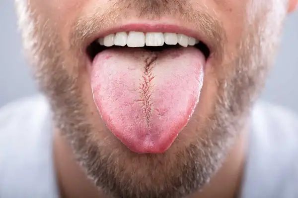 Primer plano de la boca de un hombre con barba, mostrando su lengua rosada con una **lengua blanca al final** y una grieta central.