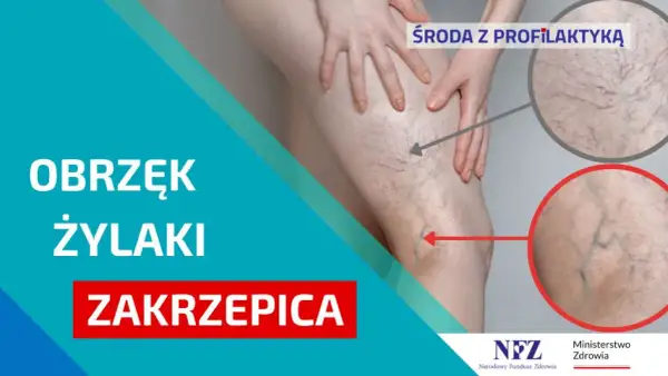 Zakrzepica: Jak skutecznie zapobiegać? Porady, które ratują życie