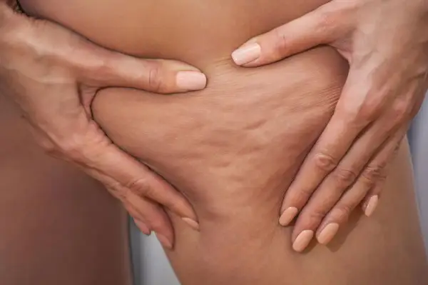 Hände greifen in die Haut, um Cellulite zu zeigen. Viele fragen sich, ob und wie geht cellulite wieder weg.