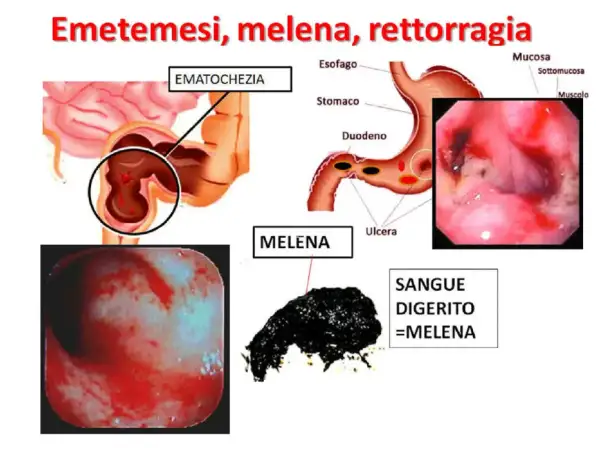 Illustrazione medica che mostra ematochezia e melena, sintomi di sanguinamento gastrointestinale, inclusa la presenza di sangue nelle feci.