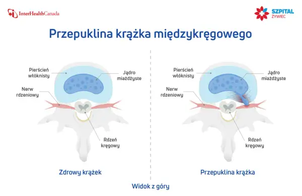 Porównanie zdrowego krążka międzykręgowego i krążka z wypukliną uciskającą nerw rdzeniowy. Widok z góry.