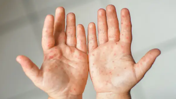 Hautausschlag an den Händen, möglicherweise durch eine Vitamin C-Allergie verursacht. Rote Flecken auf der Haut.