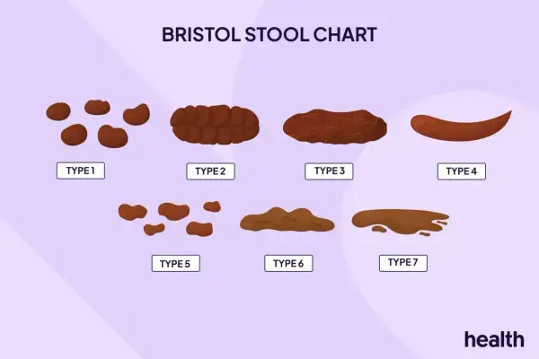 Wykres Bristolskiej Skali Stolca pokazuje 7 typów, od twardych grudek (typ 1) po płynne (typ 7). Typ 6 i 7 mogą wskazywać, ile trwa biegunka.