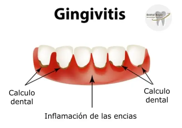 Ilustración de gingivitis con cálculo dental y encias muy inflamadas.