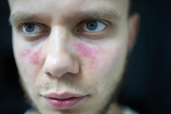 Czerwone plamy na policzkach mężczyzny, przypominające objawy tocznia rumieniowatego, z delikatnym połyskiem.