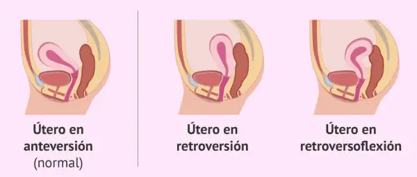 Ilustración comparativa de la posición del útero: anteversión (normal), útero en retroversión y útero en retroversoflexión.