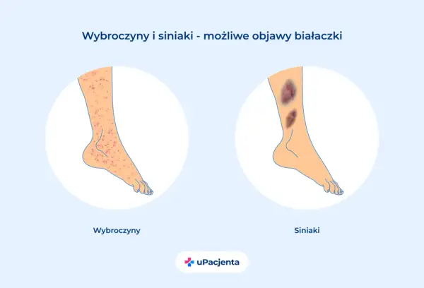 Ilustracja przedstawia nogę z wybroczynami i siniakami, jako możliwe objawy białaczki.