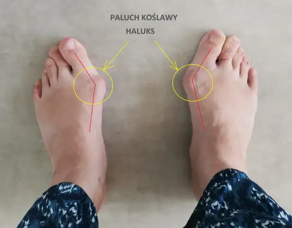 Do jakiego lekarza z haluksami? Ortopeda, podolog, fizjoterapeuta